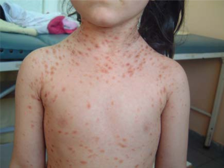 Pityriasis Rosea In Children Pictures Photos