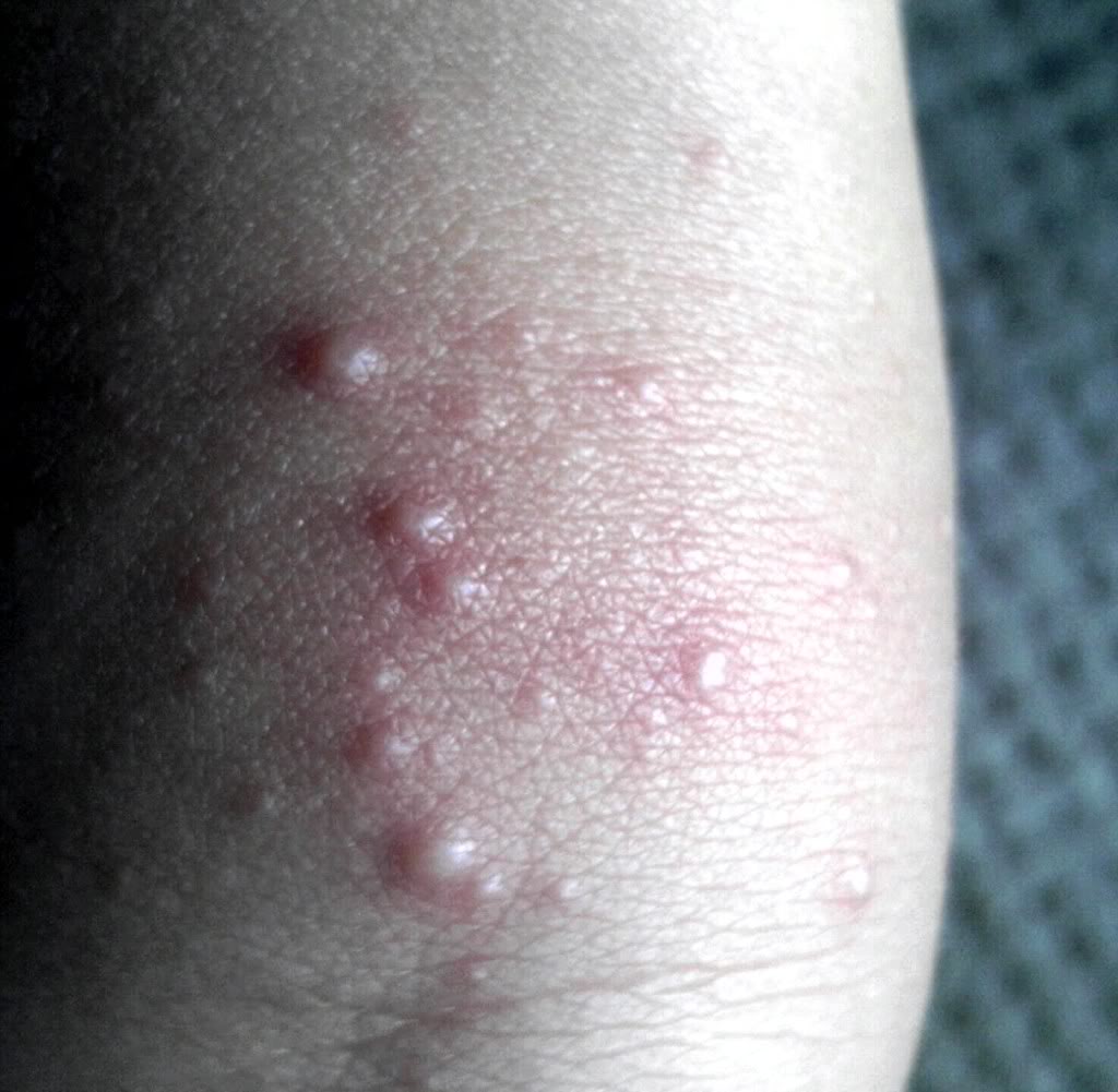 Rash On Back Of Knees Pictures Photos