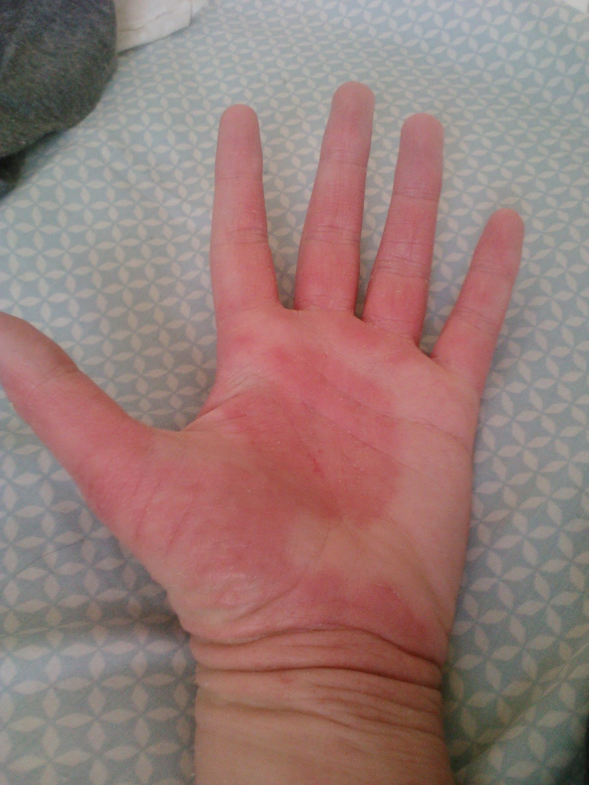 Why Are My Hands Red Itchy And Swollen