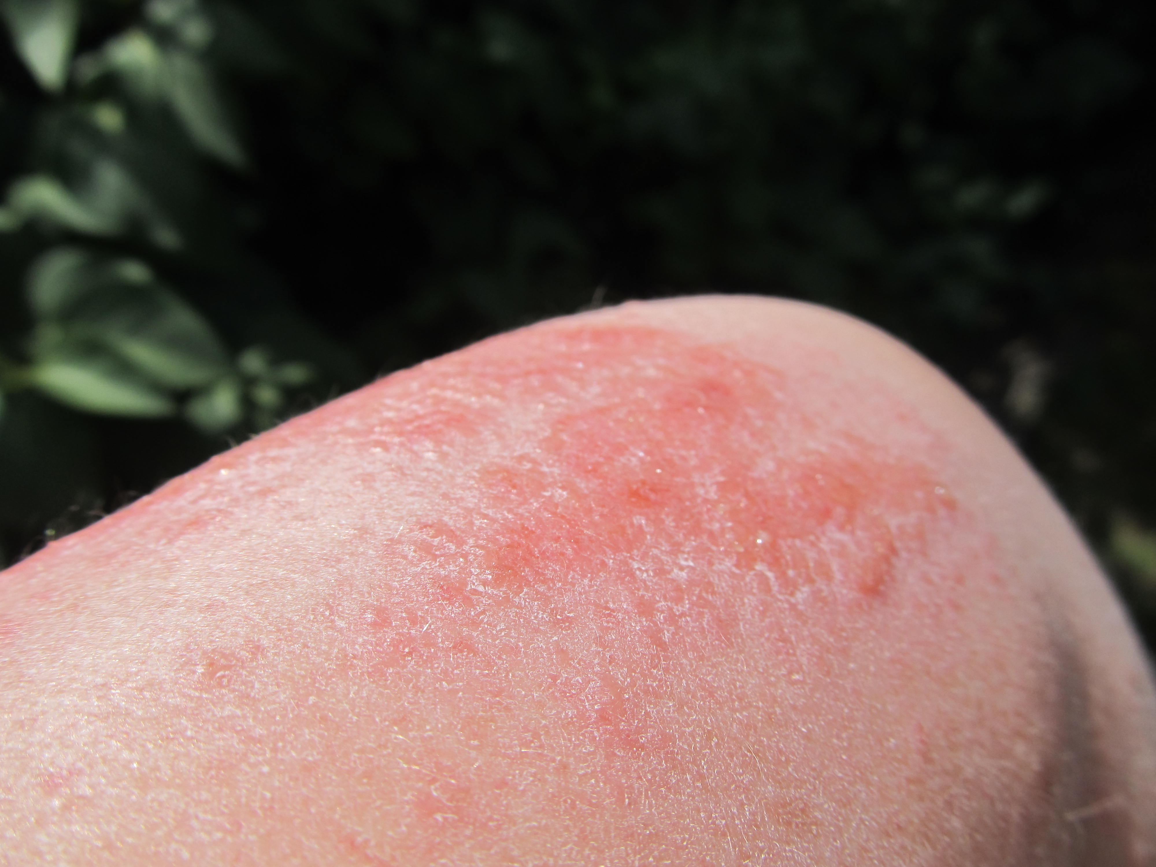 pics-of-poison-ivy-rashes-pictures-photos