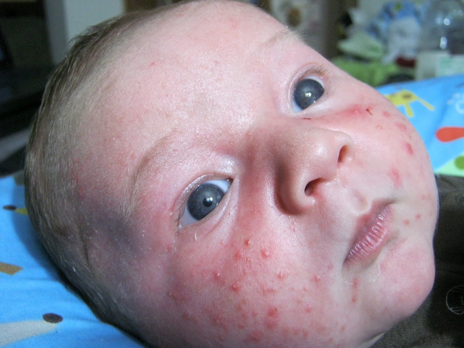 newborn-acne-pictures-photos