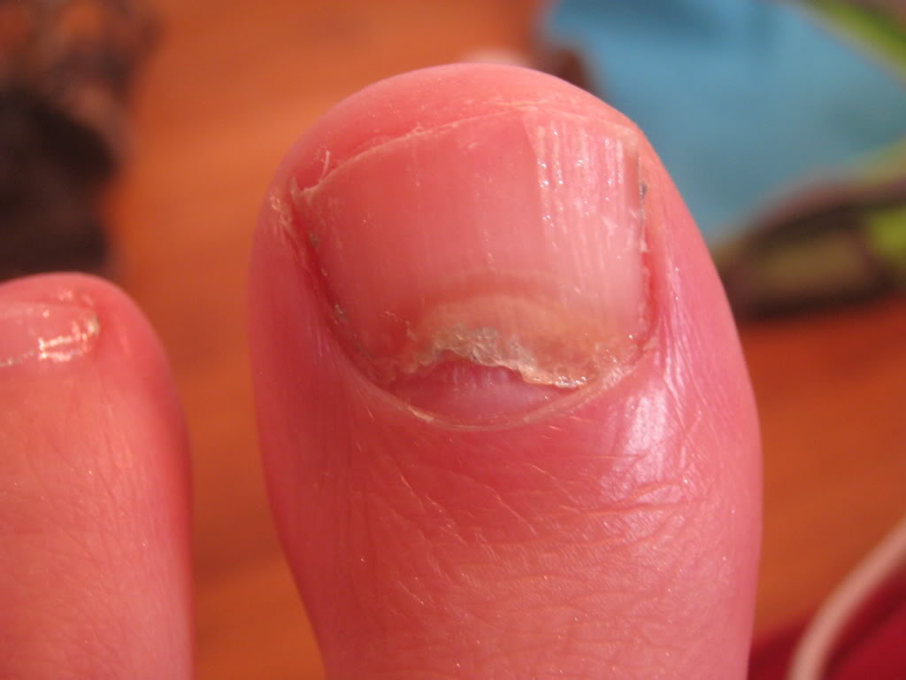 broken-toenail-transformation-at-home-diy-toe-nail-extension-for