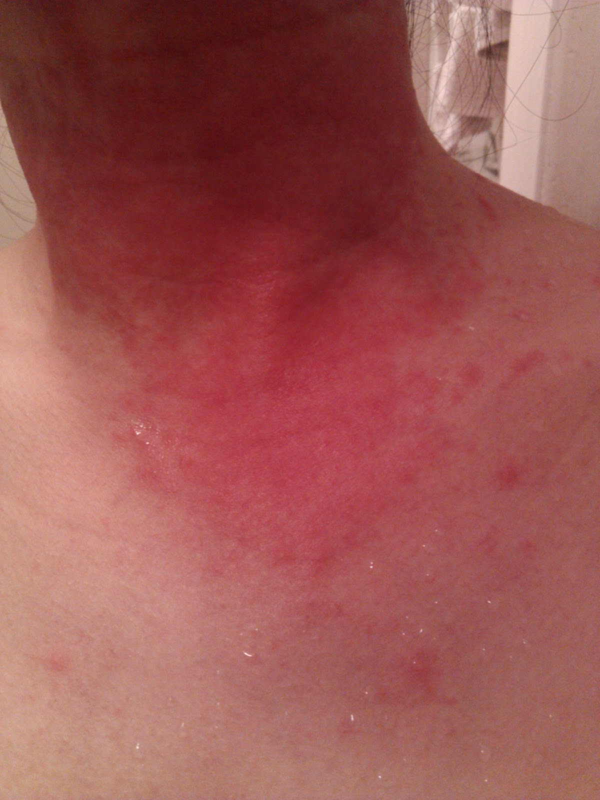 allergic reaction to bactrim pictures, photos