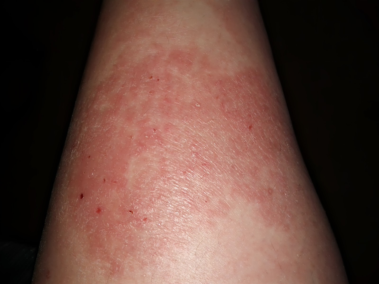 chronic skin rashes that itch