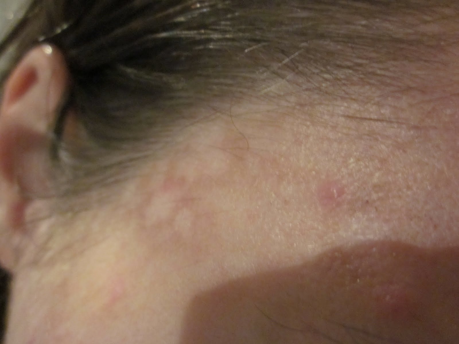 post-inflammatory-hypopigmentation-pictures-photos