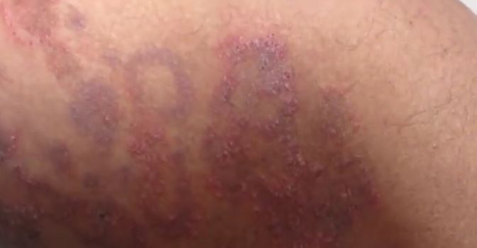 skin rash on thigh pictures, photos