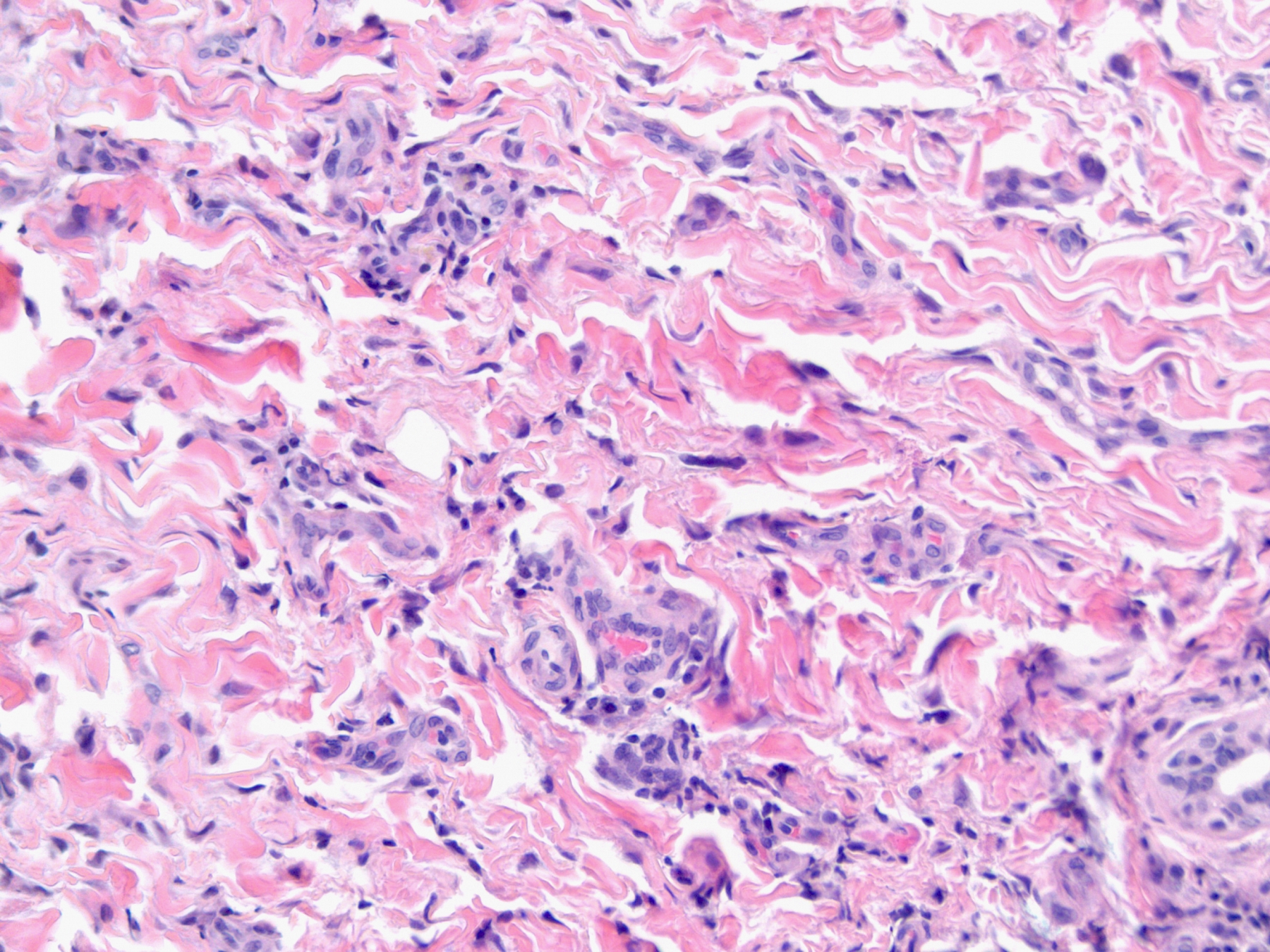 giant cell fibroblastoma - pictures, photos