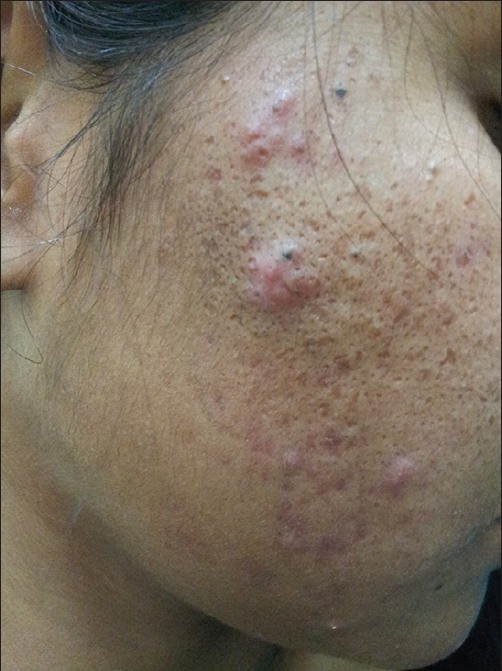 polycystic ovarian syndrome acne - pictures, photos