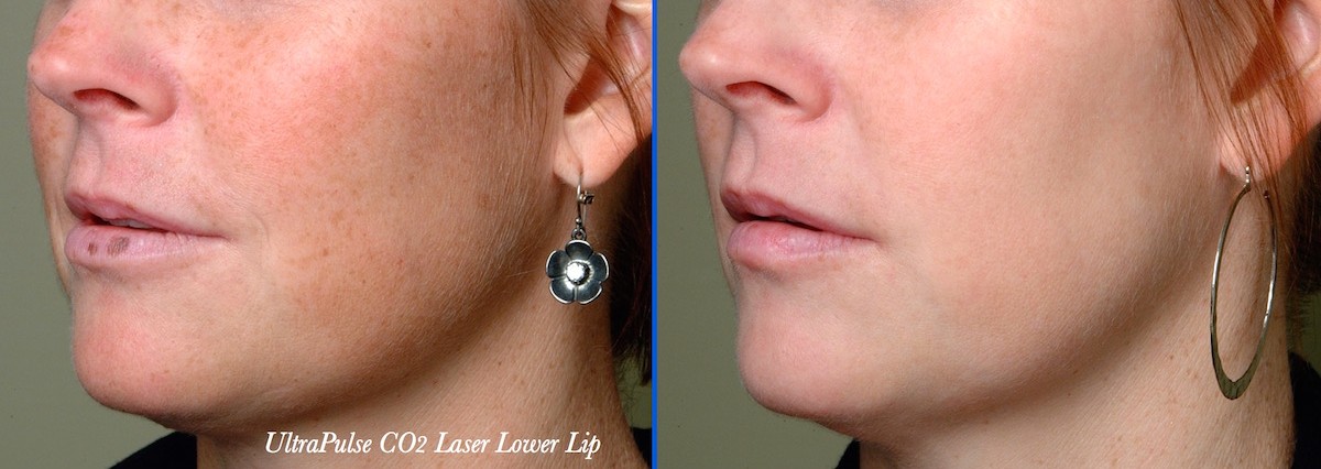 intense pulsed light rejuvenation