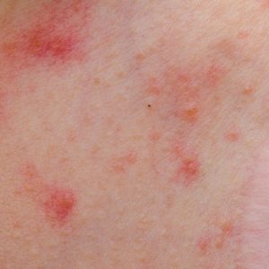 rash from ibuprofen - pictures, photos