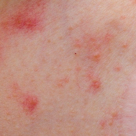 herpes on neck pictures - pictures, photos