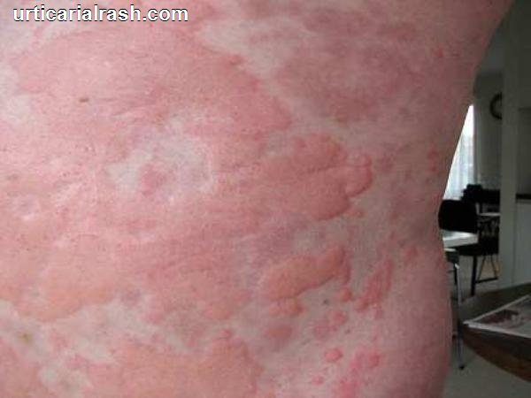 red rashes on skin - pictures, photos