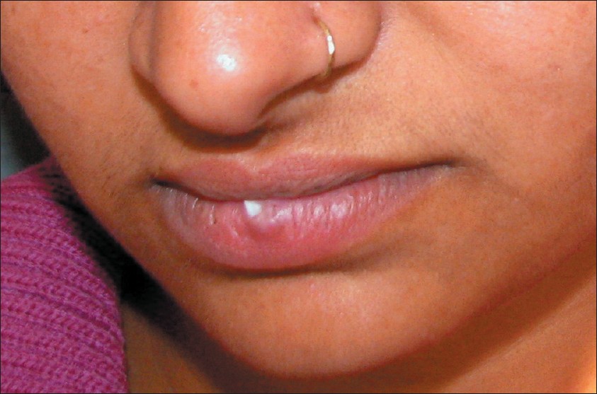 Hard Bump Inside Lip Piercing