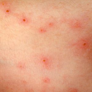 rash under the armpit - pictures, photos