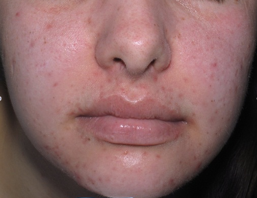 post inflammatory hyperpigmentation treatment - pictures, photos