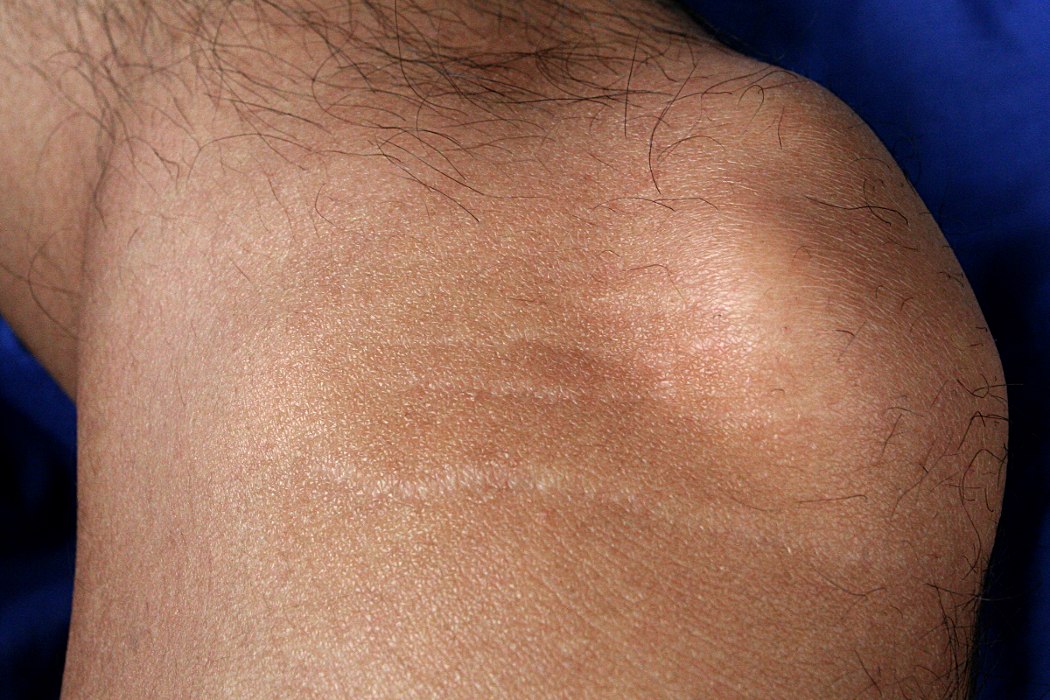 Stretch Marks On Knee Pictures Photos