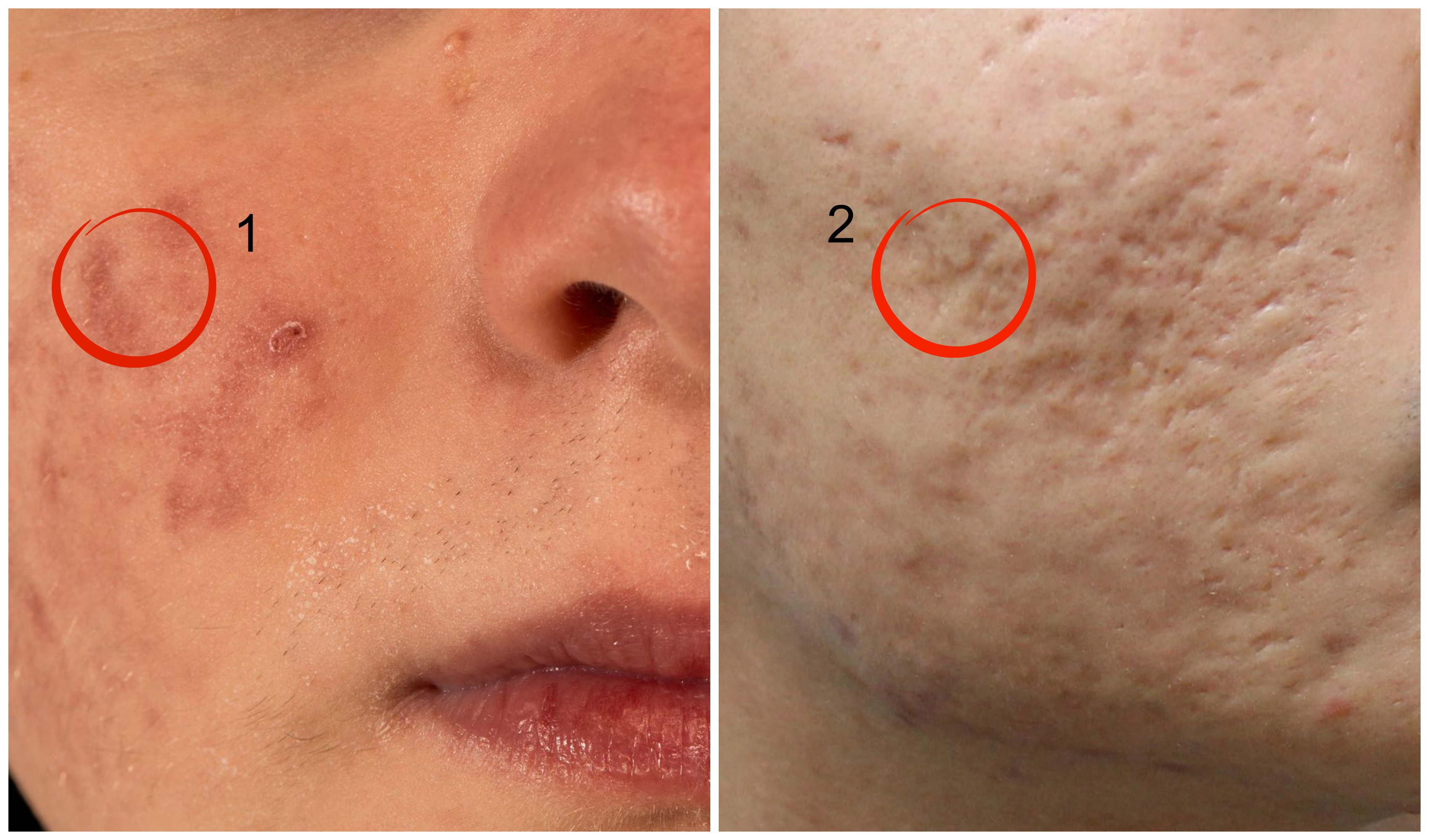 acne-lesion-pictures-photos