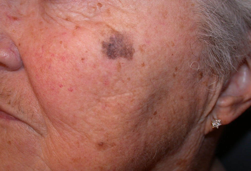 lentigo maligna melanoma pictures - pictures, photos