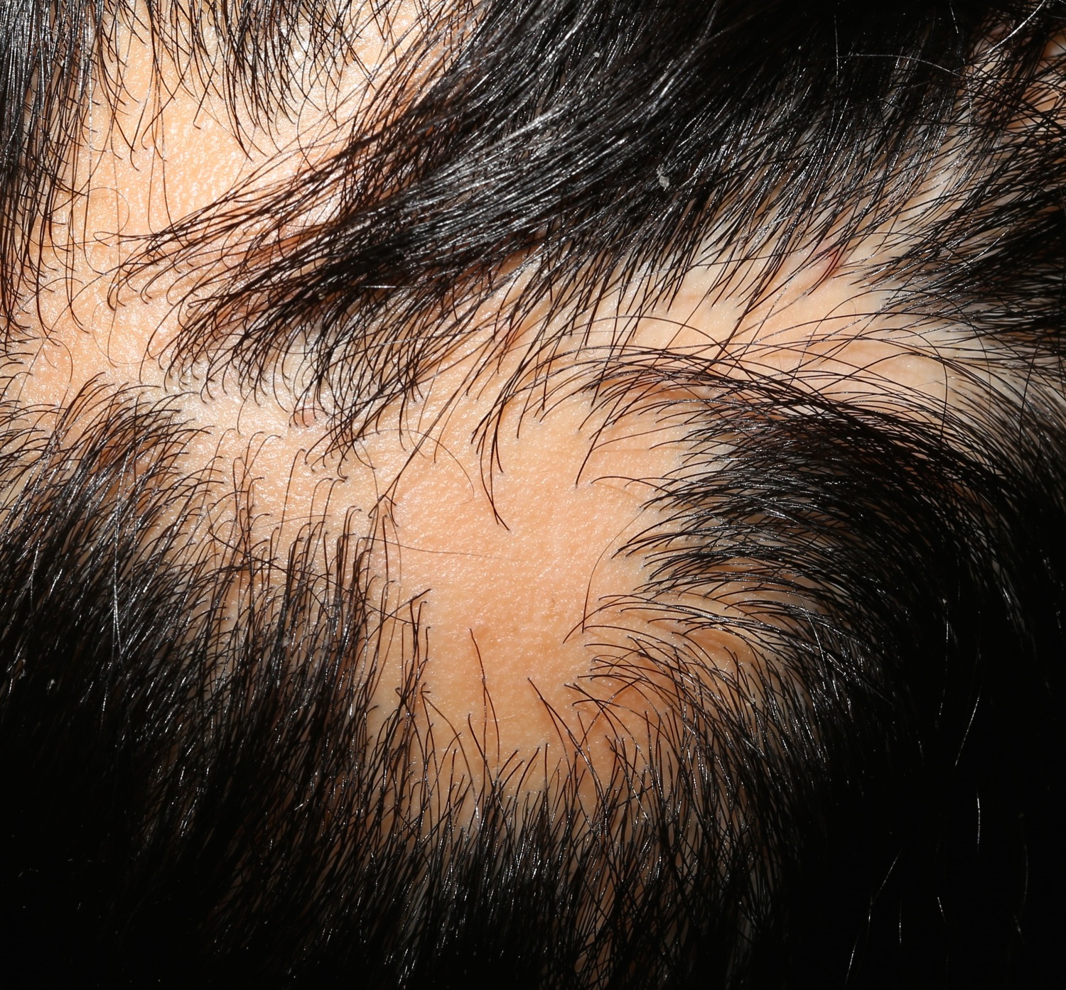 Lichen Planus Scalp Symptoms