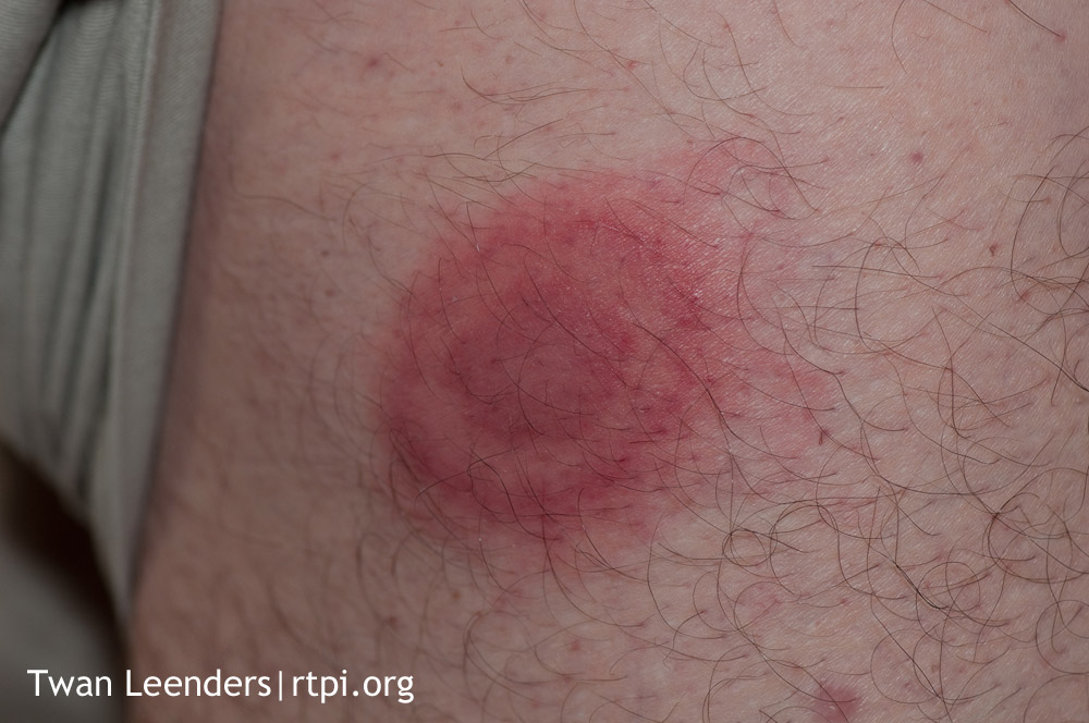 Lyme Disease Bullseye Rash