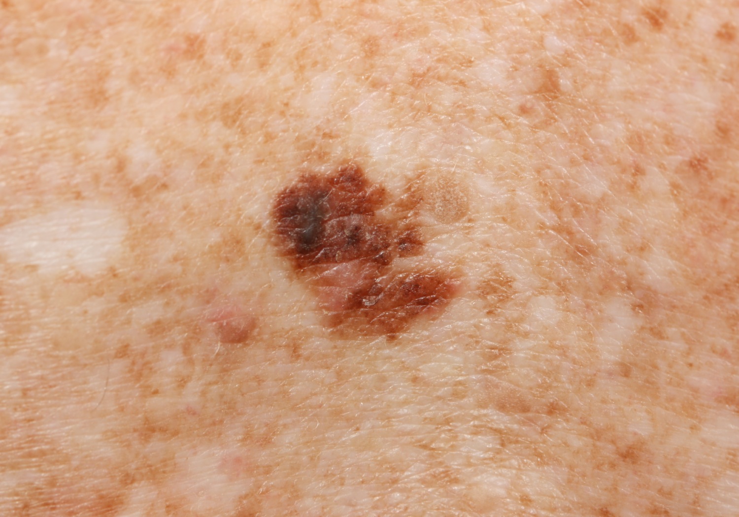 melanoma-recurrence-after-surgery-youtube