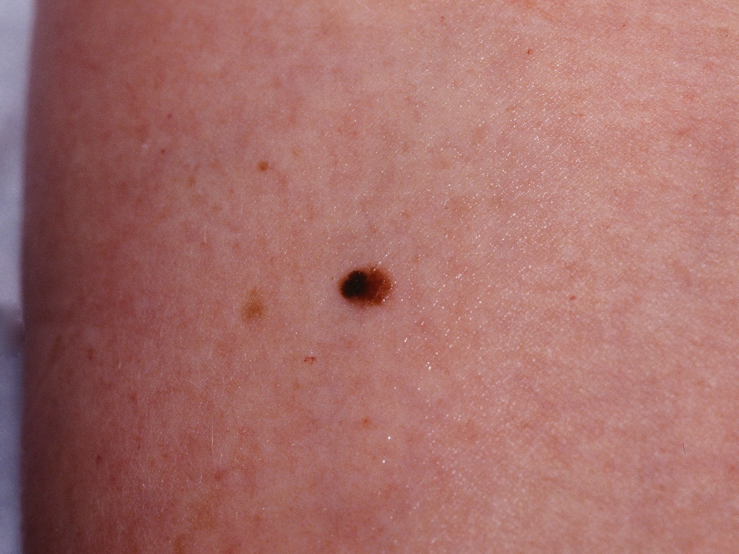 Melanomas In Situ Pictures Photos