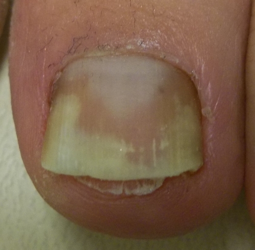 risks-of-diabetic-black-toenail-discoloration-black-toenail-fungus