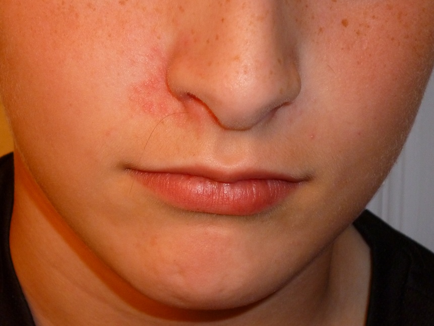 dermatitis around nose - pictures, photos