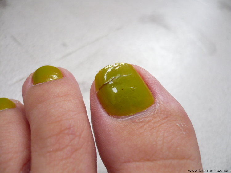 toenails-splitting-vertically-pictures-photos