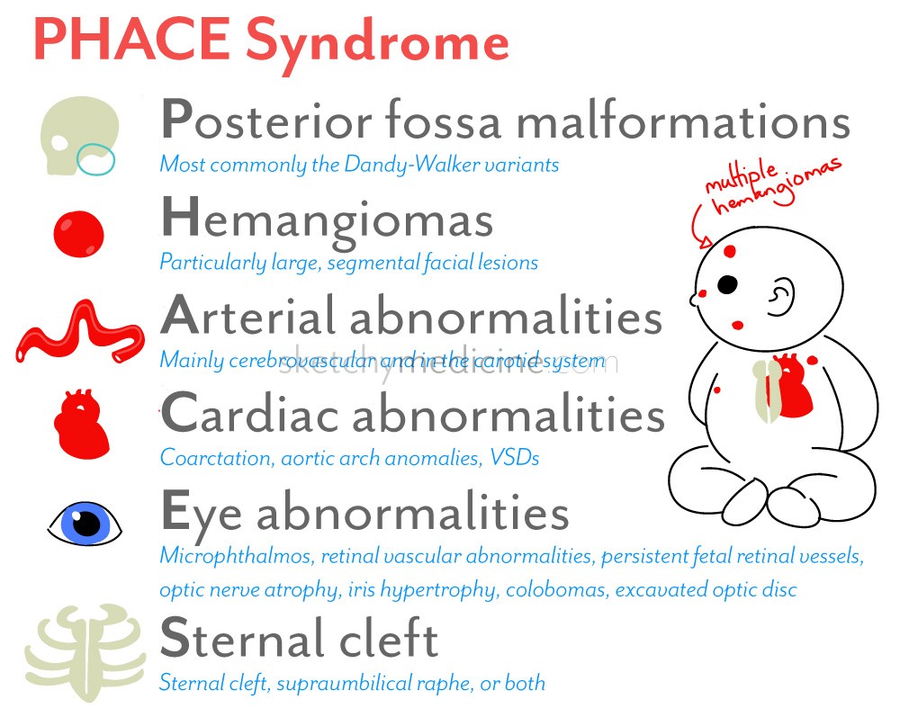 phace syndrome - pictures, photos