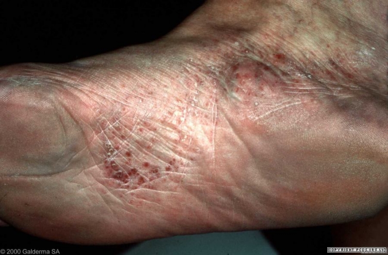 pics of eczema on feet        <h3 class=