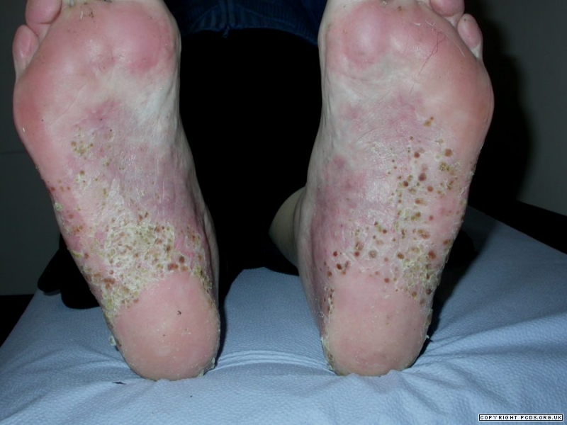 palmoplantar pustular psoriasis pictures, photos