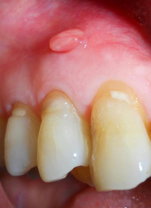 abscess-on-skin-pictures-photos