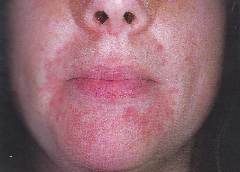 Can Tomatoes Cause Perioral Dermatitis