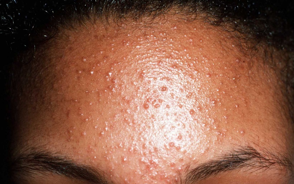 fungal-skin-rash-yeast