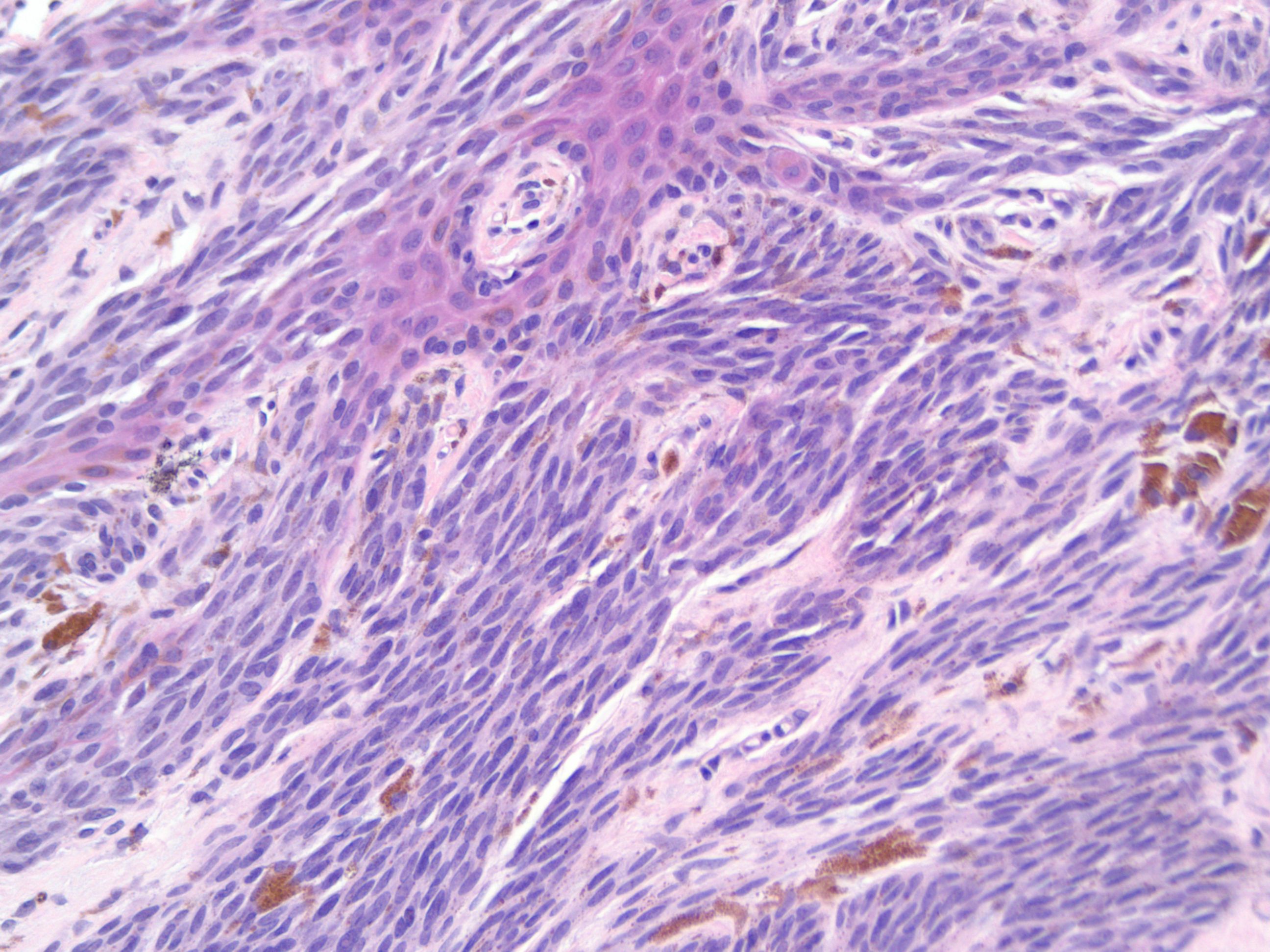 spindle cell melanoma