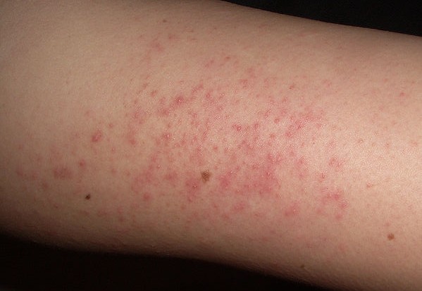 how to get rid of small pimples on my arms