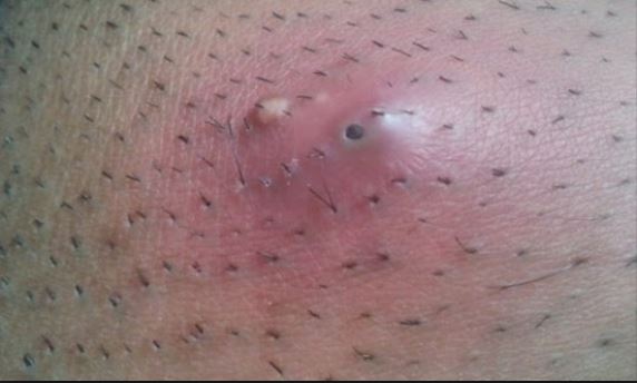 Itchy Outer Labia Pictures Photos
