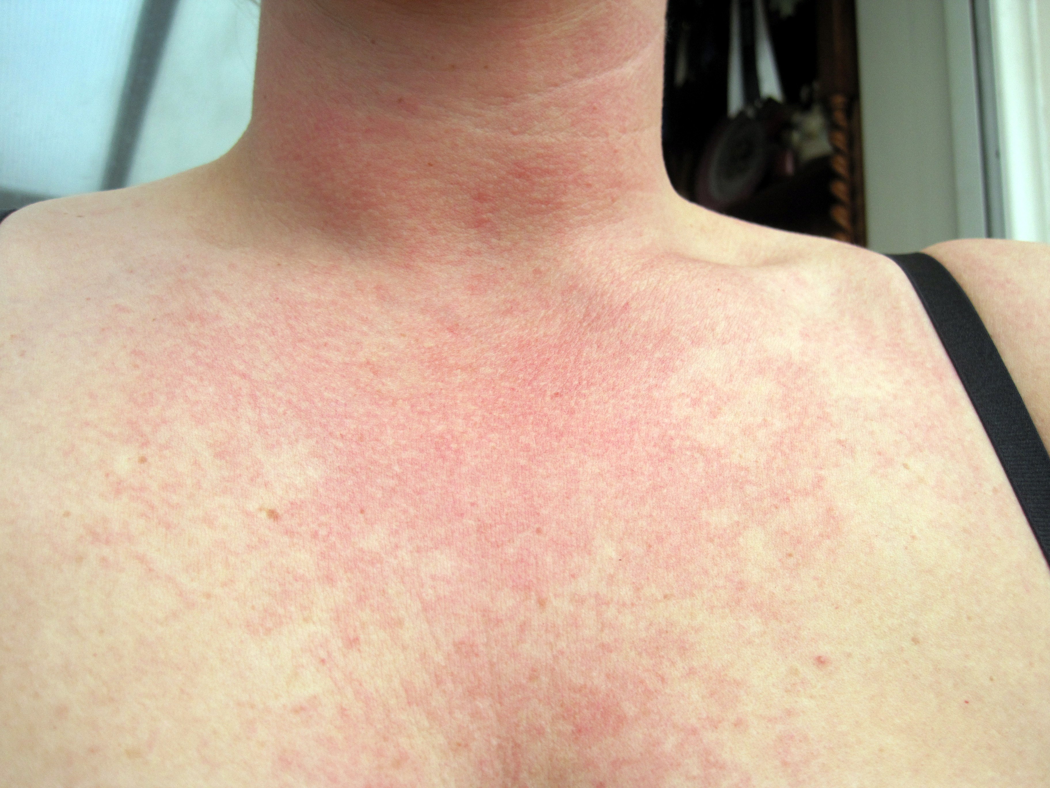 red-blotches-on-chest-pictures-photos