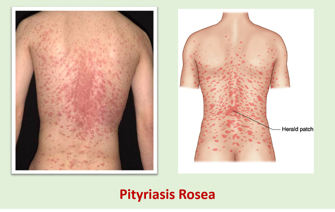 how-do-you-get-pityriasis-rosea-pictures-photos