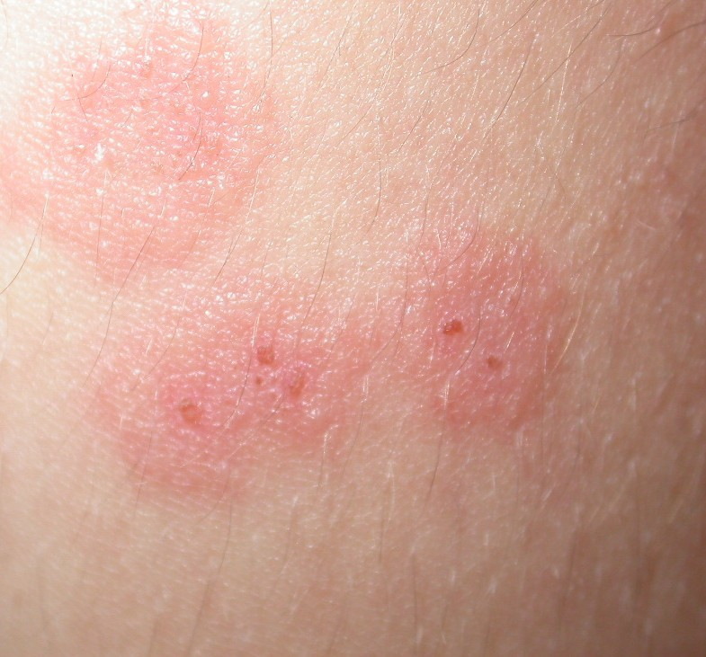 Pityriasis Skin Condition Hot Sex Picture