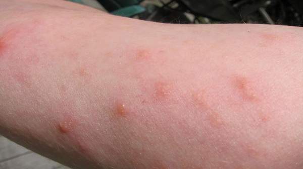 what does mild poison ivy look like what does mild poison ivy look like