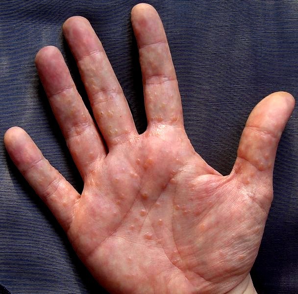 watery-blisters-on-hands-pictures-photos