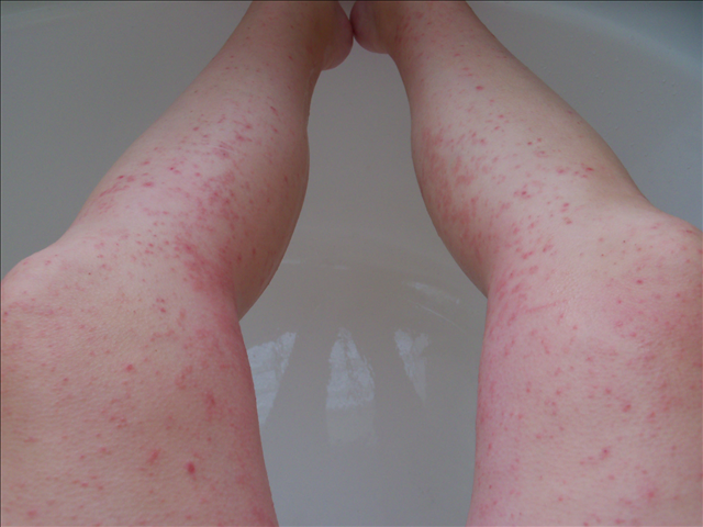 red-rash-on-lower-legs-pictures-photos