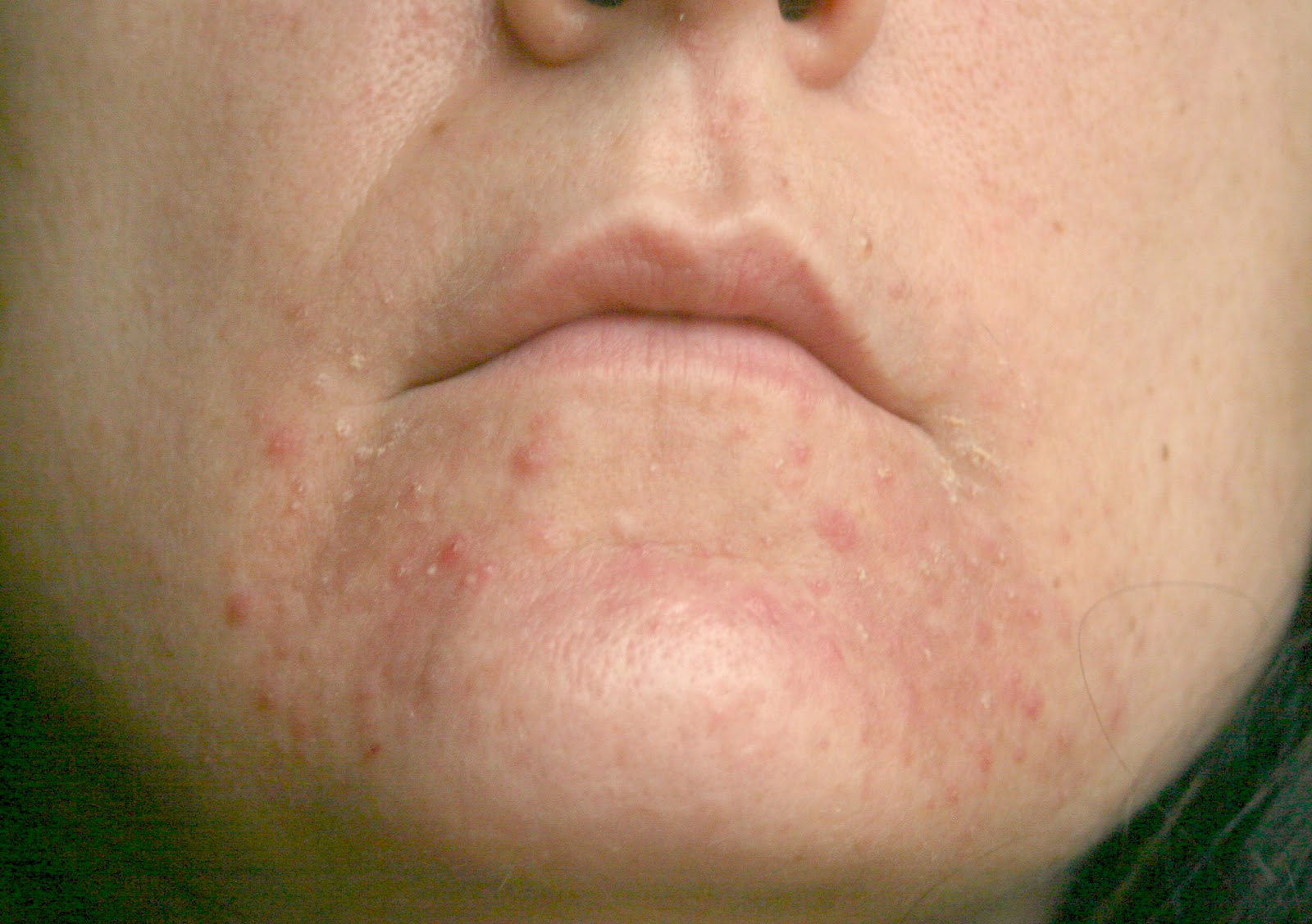 staph-infection-face-pictures-photos