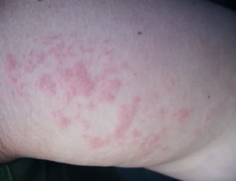 Liver Disease Rash Pictures Photos