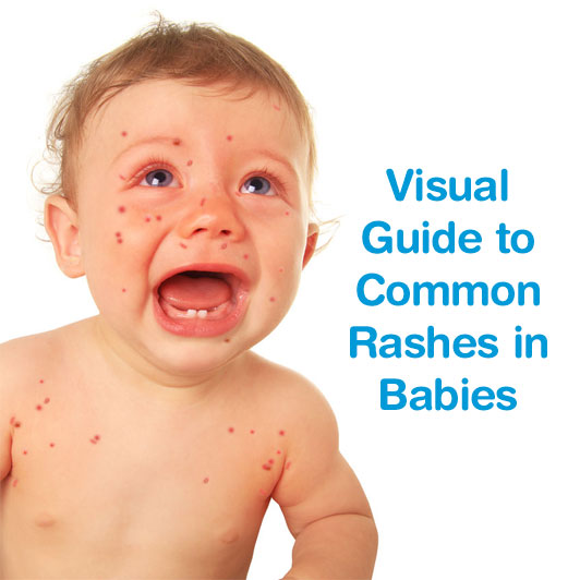 Newborn Rashes And Skin Conditions