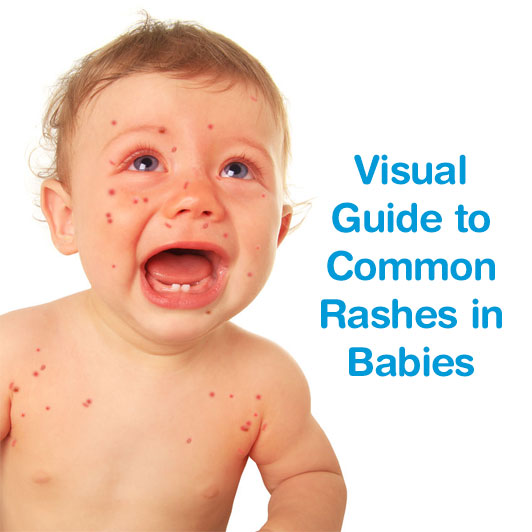 What Causes Heat Rash On Baby at Joseph Heil blog