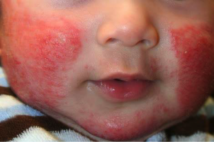 red bumps on cheeks pictures, photos