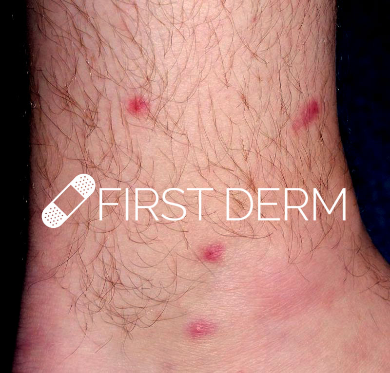Small Red Bumps On Feet - Pictures, Photos